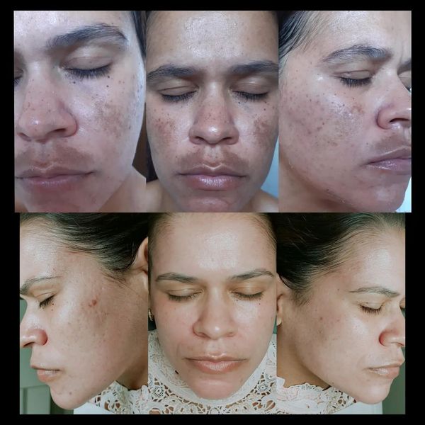 Cicatridiva Creme Clareador de Pele Contra Manchas e Melasma - COMPRE 1 E LEVE 2